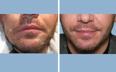 Before and After